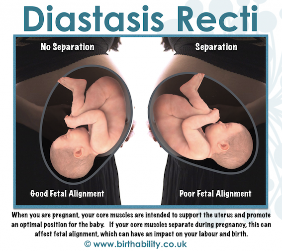 Diastasis Recti – What does it mean for Pregnant and Postnatal
